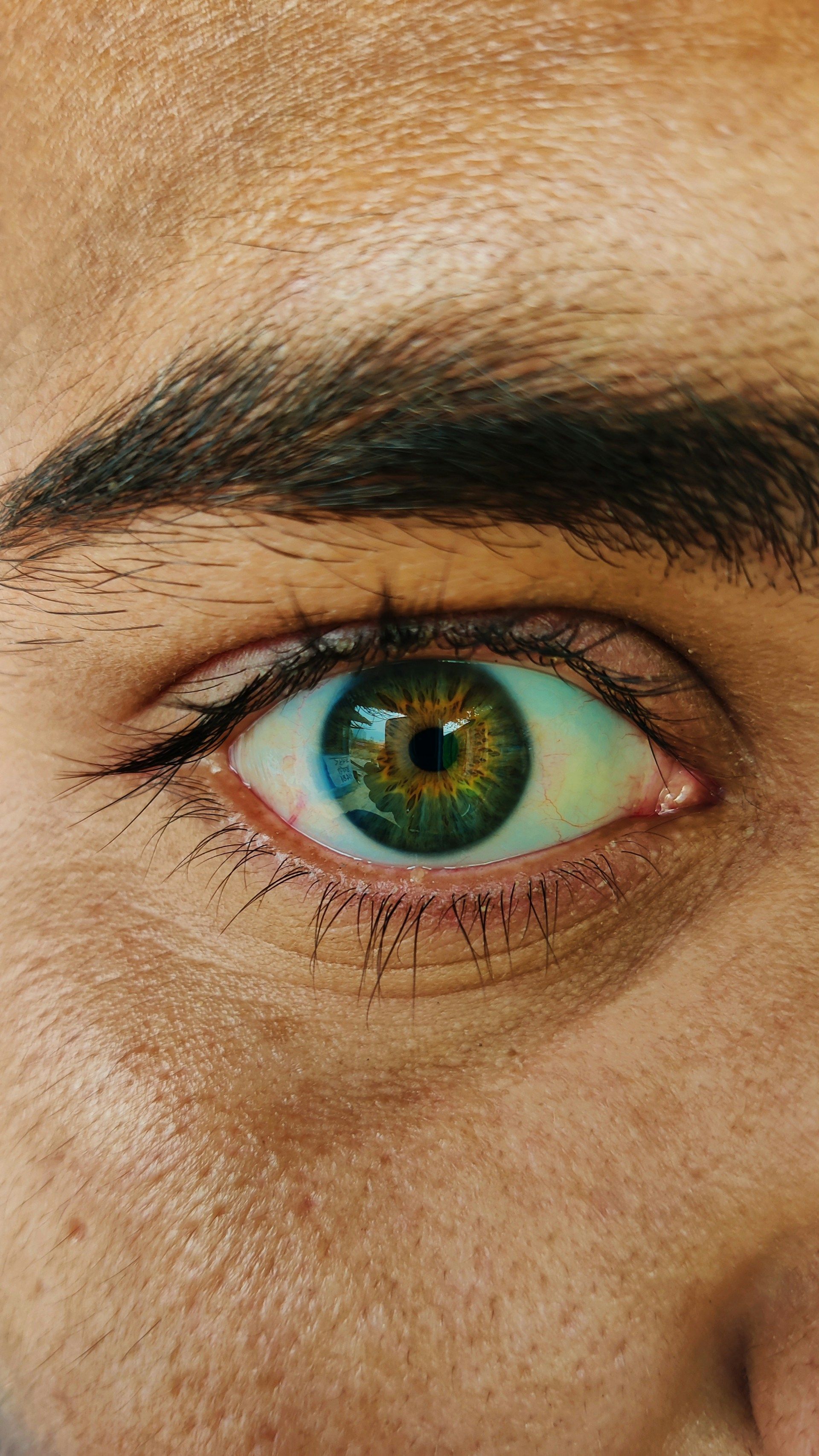 Close-up of a red, irritated eye
